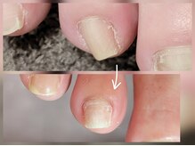 エーケーネイル(AKnail)/親指以外巻き爪補正