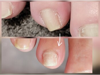 エーケーネイル(AKnail)/親指以外巻き爪補正