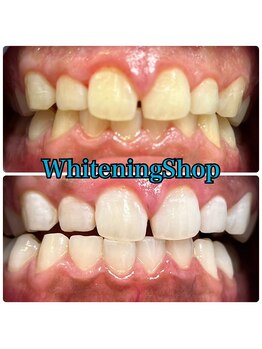 ホワイトニングショップ 吉祥寺店/BEFORE ＆ AFTER