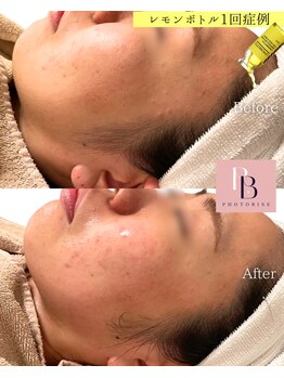 フォトビズ/二重顎改善！レモンボトル