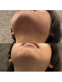 フェリーバ(FELIVA)/Before&After