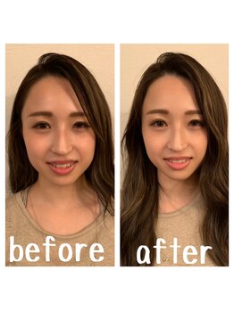 ボディーワークス 新町(BODY WORKS)/院長施術の美容鍼ビフォーアフタ