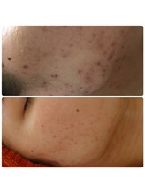 京都美顔/フェイスラインニキビケア