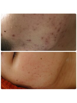 京都美顔/フェイスラインニキビケア