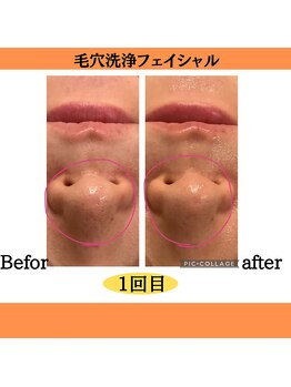パルティノ 高崎店/毛穴洗浄フェイシャル