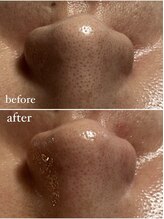 スパークル/ワックス/毛穴/毛穴洗浄/小顔