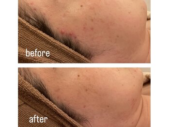 エミュ(emu)/ゆらぎ肌before/after