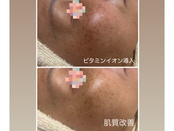 トータルビューティー ココ(Total Beauty CoCo)/50代・クールビタミンイオン導入