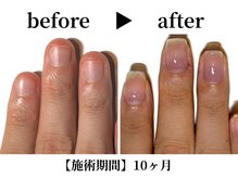 リング ザ ベル(ring the bell)/深爪プレミアムコース¥18,700