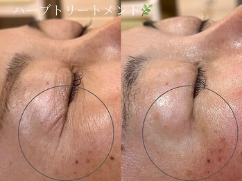 サロンドボーテ オランジュ(salon de beaute Orange)/ハーブトリートメント