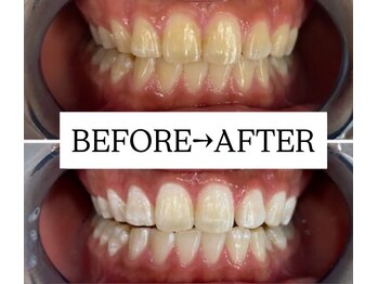 ホワイトニングサロン 宝塚/Before&After美白ホワイトニング