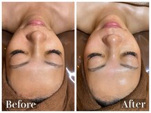 ラナ(Lana)/白玉フェイシャルワックス脱毛