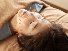 さわらび/施術風景(美容鍼)