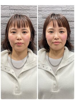 長寿鍼灸院 長寿整骨院/美容鍼50本の効果★小顔効果