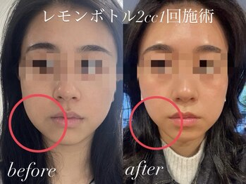 ビューティーサロン プティ(beauty salon petite)/レモンボトルお顔の脂肪分解1回