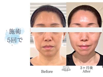 ディアスマイル(Dear.smile)/施術5回で