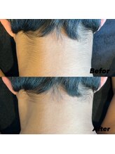 ブラックベルベット 24(BLACK VELVET 24)/【襟足脱毛】