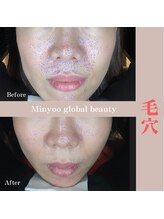 ミニョ コリアンビューティー(Minyoo korean beauty)/症例写真/AI肌診断　毛穴結果