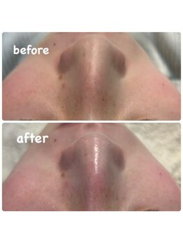 バイカラー(BY COLOR)/【毛穴洗浄】