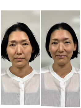 長寿鍼灸院 長寿整骨院/ハリネズミ女優美容鍼効果★