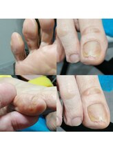 ドクターネイル爪革命 長野店/【肥厚・変形爪】ネイル/フット