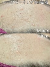 ビエン(bien)/施術3回.陶肌ハーブピーリング