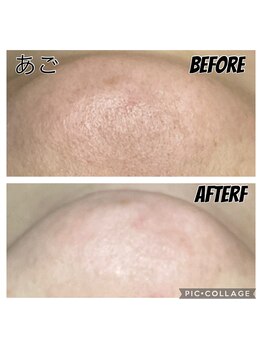 フリージア(Beauty Salon Freesia )/美肌菌活ピール 1回 乾燥肌改善