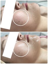 ジュエルビューティー(Jewel Beauty)/本気の肌改善　しみ！