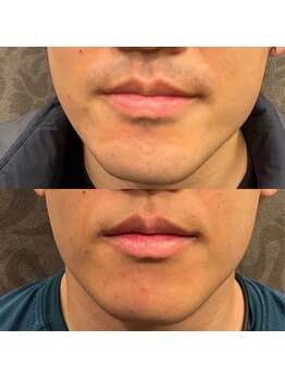 フェリーバ(FELIVA)/Before&After