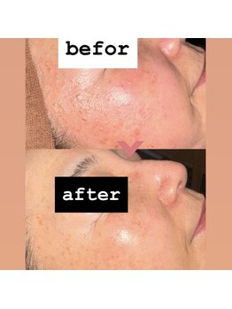 アラモア(ARAMOA)/施術一回で水光艶肌に