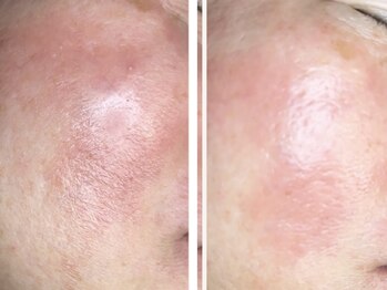 コハク(kohaku)/エレクトロポレーションb/a