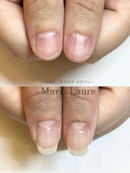 マリーロール 淀屋橋本店(Marie Laure)/自爪育成/深爪矯正/ネイルケア