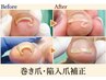 【巻き爪補正4ヶ所】+【足の爪切りセット】¥22.000