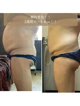 ヴィオテラス(VIOTERACE)/脂肪燃焼セラム＋ラジオ波