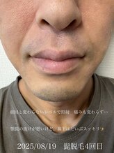 コモレビ(comorebi)/髭脱毛体験談　4回目