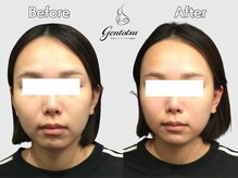 ゲントツ 新宿/小顔　小顔矯正