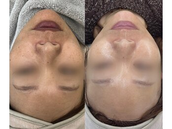 ラ ミュエル(La miel)/韓国シェアNo. 1オメガライト