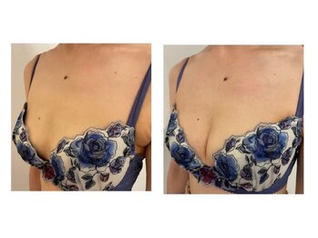 スマイルクルー(SmileClue)/ビフォーアフター症例