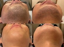 ウナ 西中島店(UNA)の雰囲気（通いやすいお値段設定！メンズ脱毛4,980円～！）