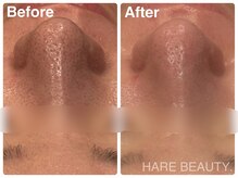 ハレビューティー 北千住(HARE BEAUTY.)の雰囲気（【ハイドロ毛穴洗浄】黒ずみ・ザラつき・角栓OFF◎透明感）