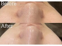 エミアンジュ(Emi Ange)/毛穴洗浄エステ/黒ずみ/毛穴