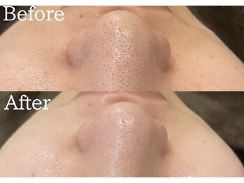 エミアンジュ(Emi Ange)/毛穴洗浄エステ/黒ずみ/毛穴