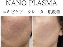 長年のニキビトラブル、しつこいニキビにお悩みの方に【NANO PLASMA】