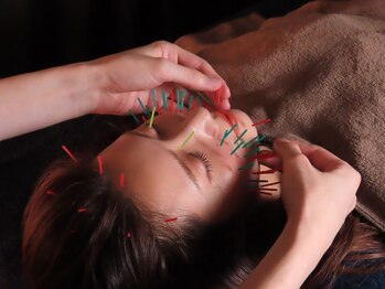 鍼灸チャンドラ(鍼灸Chandra)の写真/小顔美容鍼でむくみ＆たるみ＆シワを改善◎高リピート率を誇る院長施術でくすんだブルドッグ顔を撃退!!