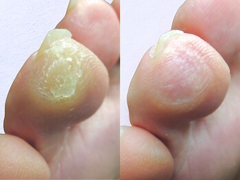 ルーム ノヘア(Room nohea)の写真/【男性にもオススメです！】本格ドイツ式フットケアでキレイでスベスベな足へ☆