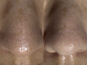 サラグランデ(Sara Grande)/毛穴コース初回9900円!