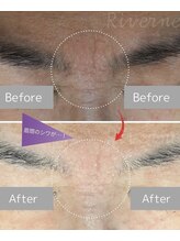 リヴェーヌ 呉羽店(Riverne)/眉間の入り込んだおシワも改善◎