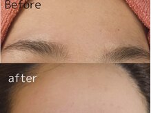 スターリィ スカイ(Starry☆Sky)/フェイシャル脱毛