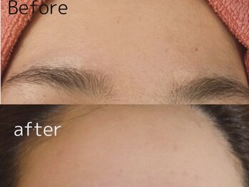 スターリィ スカイ(Starry☆Sky)/フェイシャル脱毛