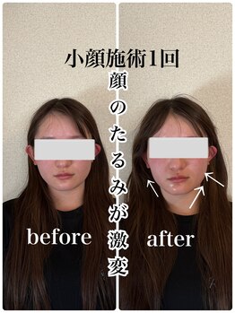 リバイブ 自由が丘店(REVIVE)/小顔矯正+ドライヘッドスパ1回